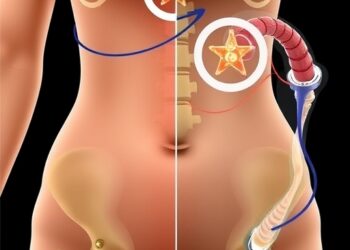 Revisional Roux-en-Y bypass after sleeve gastrectomy affects bone health in postmenopausal women