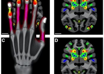 Severing a hand nerve reorganizes finger maps in primary somatosensory cortex