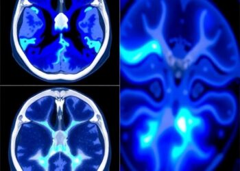 ShanghaiTech Researchers Develop Diffusion-Regularized Neural Representation to Reduce CT Metal Artifacts