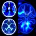 ShanghaiTech Researchers Develop Diffusion-Regularized Neural Representation to Reduce CT Metal Artifacts