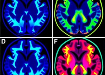 Study Compares Contrast-Enhanced Glioblastoma Resection Using Sodium Fluorescein, 5-ALA in 1,389 Patients