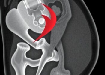 Study Compares Imaging Methods for Mapping Anterolateral Thigh Perforators