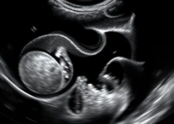 Study evaluates elastography, ultrasound, and blood biomarkers for diagnosing and predicting SOS
