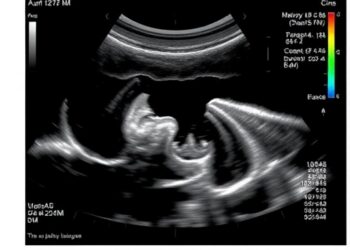 Study finds racial differences in ultrasound evaluation of suspected endometrial cancer