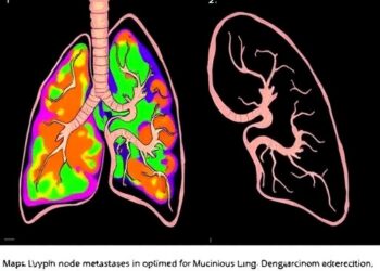 Study Maps Lymph Node Metastases, Optimizes Dissection for Resectable Mucinous Lung Adenocarcinoma