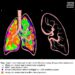 Study Maps Lymph Node Metastases, Optimizes Dissection for Resectable Mucinous Lung Adenocarcinoma
