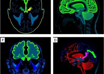 Study profiles GCase activity and α-synuclein proteoforms in Parkinson’s disease brains