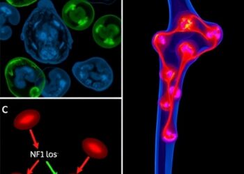 Study reveals how NF1 loss enables ER-positive breast cancer bone metastasis