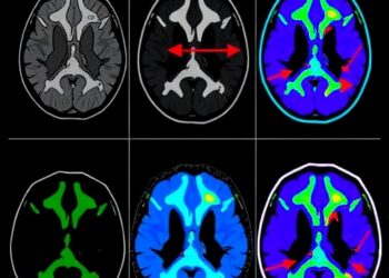 Systematic Review Compares [18F]-mFBG and [123I]-MIBG Imaging for Neuroblastoma