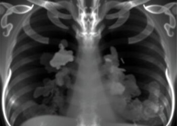 Tumor Characteristics Vary by Mammography Method in Older Women With Screen-Detected Cancer
