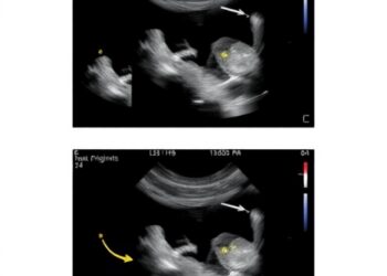 Ultrasound-Guided Nasojejunal Tube Placement Reduces Malposition and Radiation in Newborns