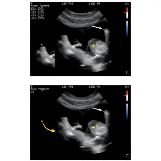 Ultrasound-Guided Nasojejunal Tube Placement Reduces Malposition and Radiation in Newborns