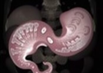 Unresectable Gallbladder Cancer Develops Rare Spontaneous Cholecystocutaneous Fistula, Case Report Finds