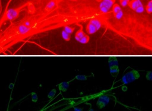 UVA-Induced Hyperploidization Causes Fibrosis in Post-Mitotic Fuchs Dystrophy Corneal Cells