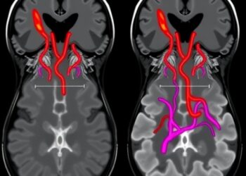 AI model detects lymphovascular invasion in breast cancer MRI scans