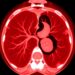 Bulbar Ulcer Reveals Rare Portal Cavernoma Diagnosis in 69-Year-Old Patient