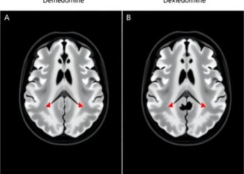 Dexmedetomidine for Aneurysmal Subarachnoid Hemorrhage: A Systematic Review and Meta-analysis