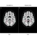 Dexmedetomidine for Aneurysmal Subarachnoid Hemorrhage: A Systematic Review and Meta-analysis