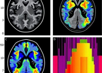 Diffusion histogram analysis forecasts survival in bevacizumab-treated recurrent IDH-mutant gliomas
