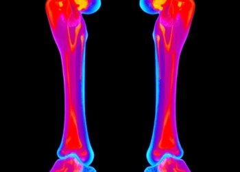 Dual radioligand therapy targets neuroendocrine bone metastases in pilot study