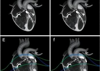 Echocardiographic changes and vascular dysfunction in male and female Fabry patients