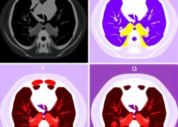 Ga-68 CTR-FAPI outperforms FAPI-04 PET/CT in radioiodine-refractory thyroid cancer study