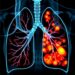 High-resolution radiomics model predicts invasiveness of pure ground-glass lung adenocarcinoma