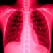 Hospital-acquired pleural infection shows worse outcomes than community-acquired cases