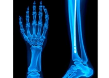 IL12Rβ1 deficiency causes multifocal osteomyelitis after BCG vaccination: a case report