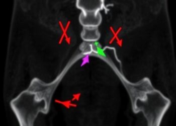 IRX1 blocks cervical cancer growth by curbing lipid synthesis enzyme ACLY