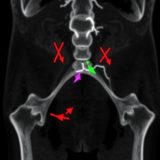 IRX1 blocks cervical cancer growth by curbing lipid synthesis enzyme ACLY