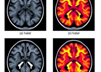Machine learning predicts functional outcomes after vestibular schwannoma surgery: systematic review and meta-analysis