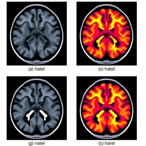 Machine learning predicts functional outcomes after vestibular schwannoma surgery: systematic review and meta-analysis
