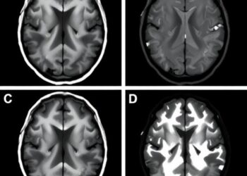MRI-Negative Temporal Lobe Epilepsy Reveals Distinct Patient Phenotypes
