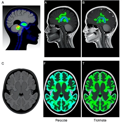 Multi-institutional RAPID Consortium analysis of molecular therapy for papillary craniopharyngioma