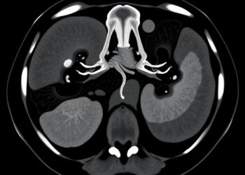Multicenter study predicts kidney cancer grade using multi-phase CT radiomics