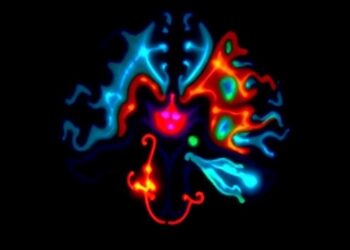 New molecular insights into intratumoral hemorrhage in IDH-wildtype glioblastoma