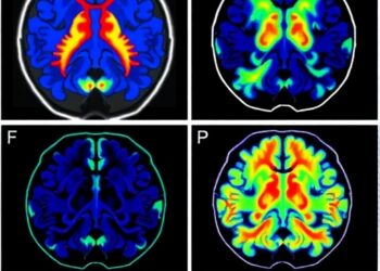 New Prediction Model Forecasts High-Grade Glioma Progression Using Radiomics and Pathomics
