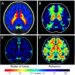 New Prediction Model Forecasts High-Grade Glioma Progression Using Radiomics and Pathomics
