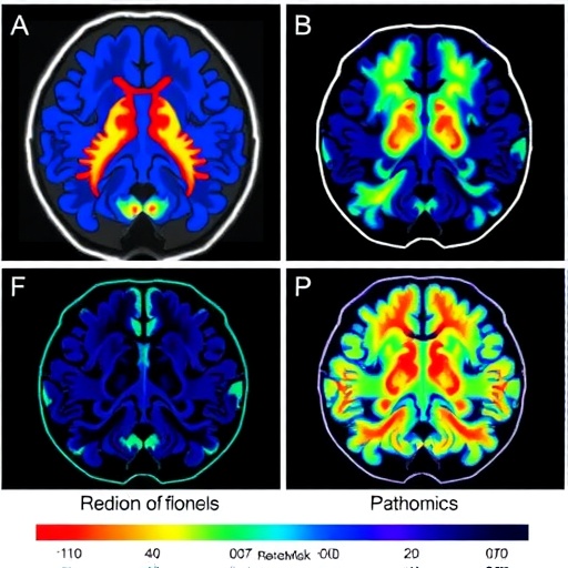 New Prediction Model Forecasts High-Grade Glioma Progression Using Radiomics and Pathomics