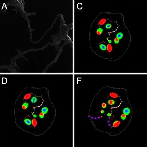 Novel AGXT2-PYCR3 macrophage subtypes identified in fatty liver disease