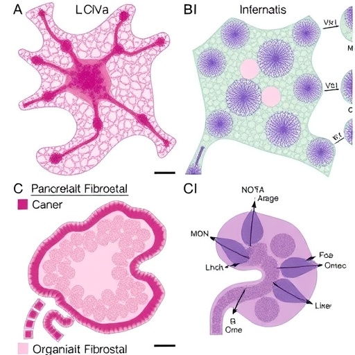 Organoid co-cultures expose epithelial and fibroblast diversity in pancreatic cancer and pancreatitis