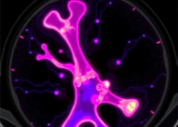 PET/CT reveals bone uptake of amyloid tracer in AL amyloidosis