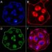 Propranolol stereoisomers show distinct effects in infantile hemangioma cells