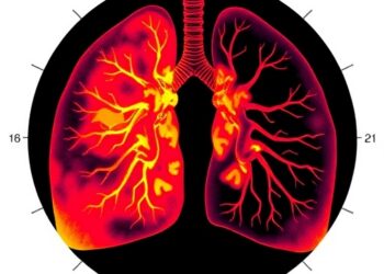 Radiomics-pathomics model predicts local recurrence in T3–4 lung cancer