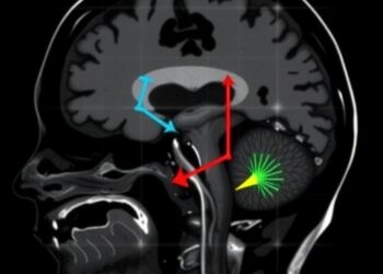 Spotting spinal CSF leaks in children: a neuroradiologist’s guide