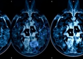 Fuzzy Logic and KAZE Algorithms Spot Hidden Breast Cancer Signs in Mammograms