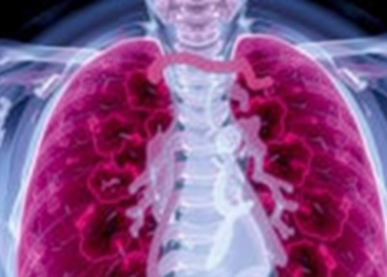 Rare Airway Aspergillosis Killed a Patient in 36 Hours