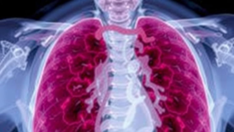 Rare Airway Aspergillosis Killed a Patient in 36 Hours