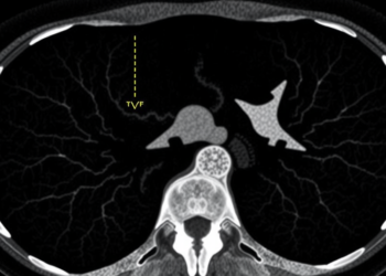 Rare Radiopaque Ring on Postmortem CT Marks Contact Gunshot Wounds, Study Finds